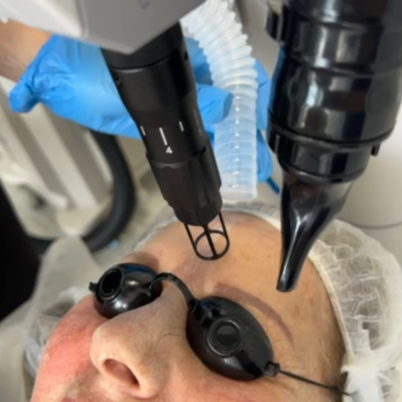 Laser_BalbasAntiaging